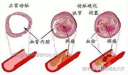 硬化血管“石化”术：医疗创新的取石奇缘